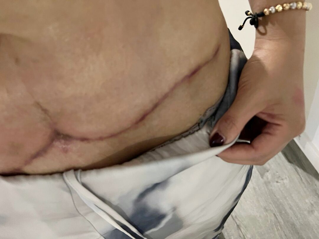 Abdomen cicatriz 01